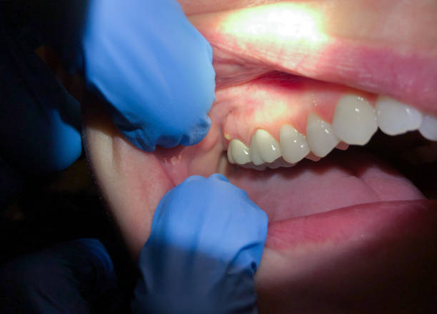 Best Emergency Care for Gum Disease in Birchwood Lakes, PA