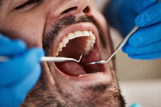 Best Knocked-Out Tooth (Avulsed Tooth) Treatment in Birchwood Lakes, PA